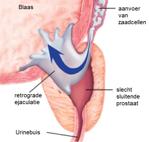 retrograde ejaculatie man